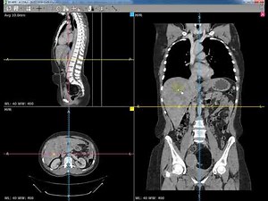 Average Density using RadiAnt Software