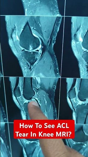 How To See ACL Tear In Knee MRI? Dr Sai Chandra MBBS DNB Ortho What's App 9573517107