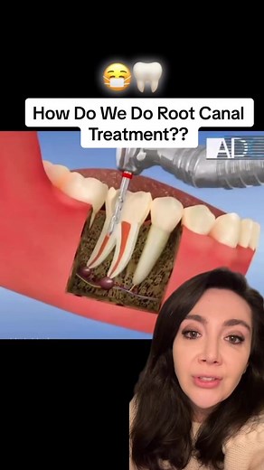 Root canal treatment is a dental procedure where the dentist removes the damaged or infected part inside a tooth, cleans it, and then seals it to prevent further problems. It helps save a tooth that might otherwise need to be removed, relieving pain and stopping infections. ➡️Disclaimer: every treatment has risks. The treatment posted on this page might not be appropriate for your oral environment. You need a full consultation with an Australian qualified dental professional before we can confir