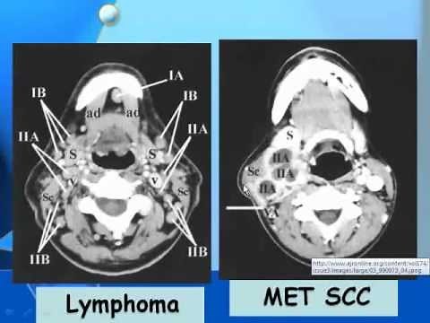 Radiology - Cervical Lymph Nodes - Head and Neck