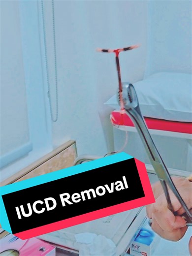 IUCD Removal #iucdmethod #iucd #contraceptiveremoval #iucdinsertion #iucdpregnancy #contraceptive #contraceptivemethods #contraceptivedevice #coppert #contraceptivepill #contraceptiveimplant ##fypp #fyp