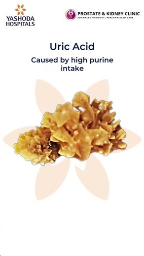 Do you know there are different types of kidney stones?