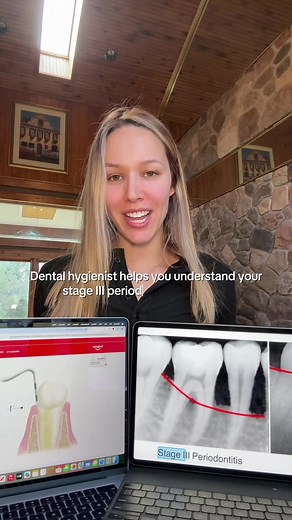 Understanding Stage Three Periodontitis Management