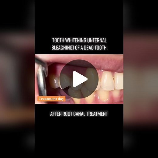 Internal Bleaching After Root Canal Treatment