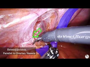 Robotically Assisted Retroperitoneal Entry and Ureterolysis • Video • MEDtube.net