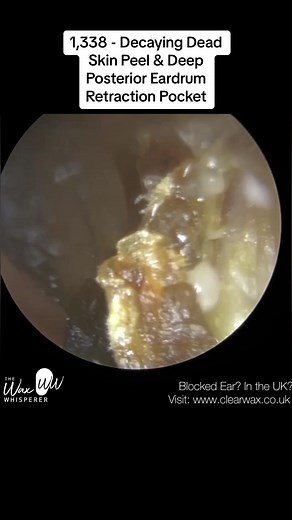 1,338 - Decaying Dead Skin Peel & Deep Posterior Eardrum Retraction Pocket #ear #earwax #earwaxremoval #earwaxcleaning #earwaximpaction #audiologist #thewaxwhisperer DISCLAIMER The information contained in the multimedia content (“Video Content”) posted has been made available for informational and educational purposes only. It does not make any representation or warranties with respect to the accuracy, applicability, fitness, or completeness of the Video Content. It does not warrant the perform
