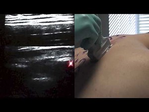 Ultrasound Guided Paravertebral Block - SSRAUSA.com