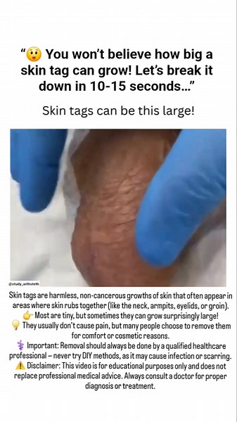 😱 Skin Tags Can Grow THIS Big?! | Shocking Medical Fact Explained