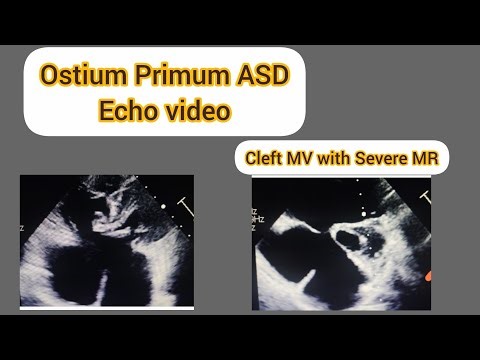 Ostium Primum ASD echo video#Atrial septal Defect echo video#Cleft MV echo
