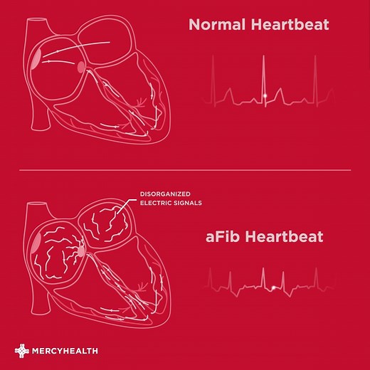49K views · 142 reactions | Atrial fibrillation (AFib) is the most common type of arrhythmia (an irregular heartbeat) and it’s treatable. Here's a look at a normal rhythm heartbeat vs. an irregular fluttering heartbeat. Know the signs, symptoms and treatment options so you don't ever have to skip a beat. | Mercy Health | Facebook
