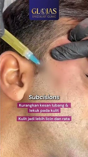 Subcision Treatment: Parut Jerawat Berlubang
