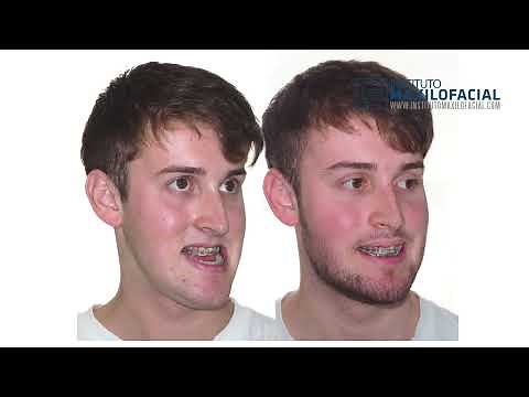 Jaw surgery Case# 118: Joan - Class III, Open bite, long face, maxillary hypoplasia