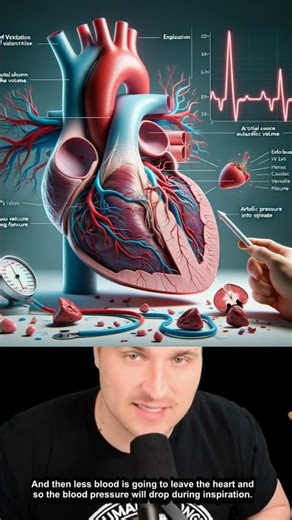 Pericarditis and Pulsus Paradoxus #usmle