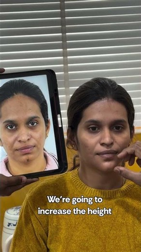 Forehead reduction and jaw surgery