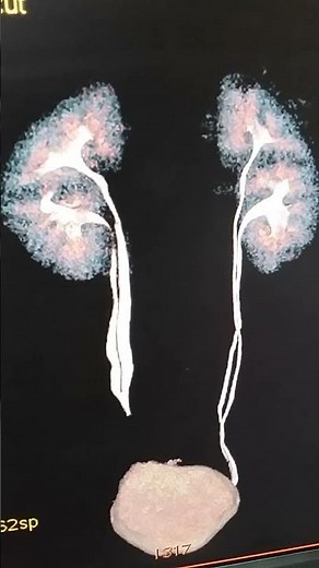 Contrast KUB CT scan double ureter with hydronephrosis