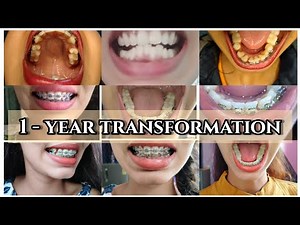 Before and after braces/ time lapse/ 1- year braces transformation#braces #bracesupdate#bracessmile