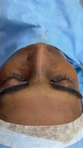 Redo Septorhinoplasty Surgery