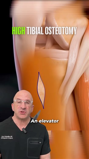 How To AVOID Knee Replacement - Osteotomy Saves Your Knee Joint