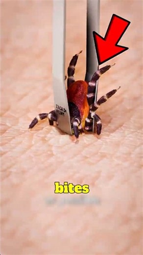 A Tick Bit You? 🚨 Don’t Pull It Out Like This!