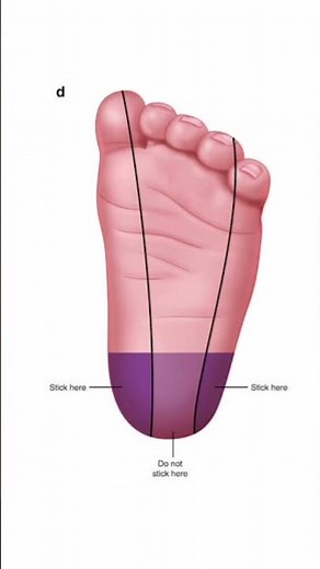 Baby heel stick blood collection #laboratory #bloodcollection #medtechstudent #mls #clssygemer