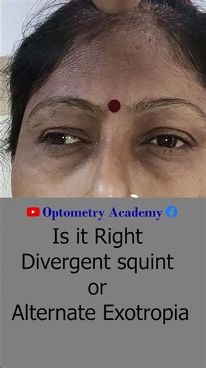 Is it Right Divergent squint or Alternate Exotropia