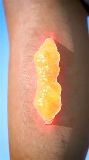 How Wounds Heal 🩸