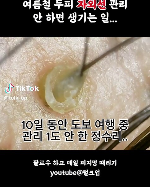 여름철 두피 자외선 차단 해야하는 이유 #squeezeyuk #fyp #피지제거 #피지 #두피 #sebum #sebumextraction #sebumremoval