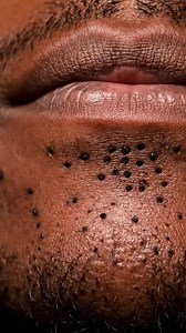 9.1K views · 25 reactions | “Super Close Blackhead Removal You Can’t Look Away | Listingpeal | Facebook