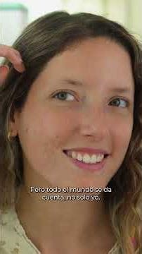 MARTINA TENIA UN ACNÉ GRADO 3