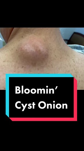 A bloomin’ 🧅 cyst #drpimplepopper #SLMDskincare