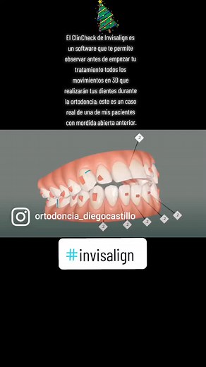 El ClinCheck de Invisalign es un software que te permite observar antes de empezar tu tratamiento todos los movimientos en 3D que realizarán tus dientes durante la ortodoncia, este es un caso real de una de mis pacientes con mordida abierta anterior. #invisalign #invisaligndoctor #invisalignlatam #invisalignmexico #coyoacan #ortodoncia #ortodonciainvisible #clincheck #ortodonciayortopediamaxilar #ciudaddemexico #cdmx