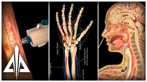 3D Nursing Procedure Medical Animation