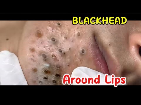 FULL OF BLACKHEAD AROUND LIPS! SATISFY ME