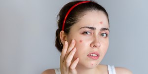 What Are The 7 Types Of Acne and How To Treat Them