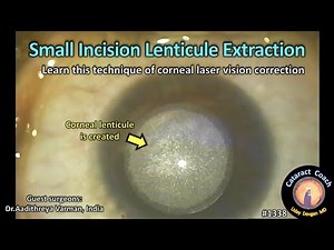 CataractCoach 1338: Small Incision Lenticule Extraction: SMILE versus LASIK laser vision surgery
