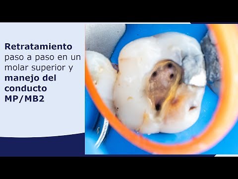 Retratamiento paso a paso en un molar superior, y manejo del conducto MP:MB2
