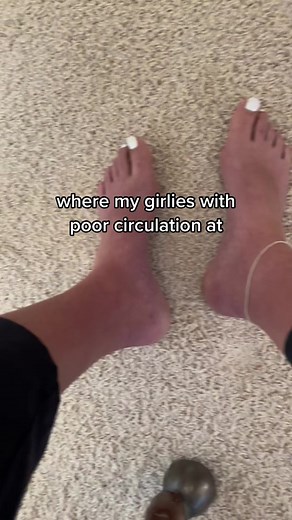 How to Improve Circulation in Cold Purple Feet