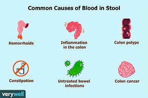 What does red blood mean in poop? [2025] | QAQooking.wiki