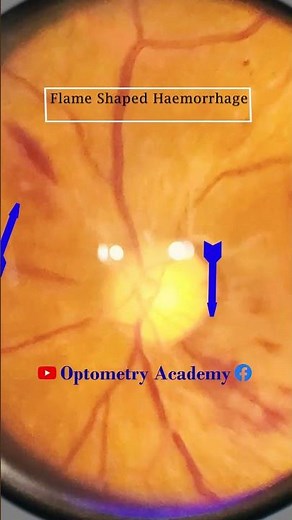 Flame shaped haemorrhage | Oedema | Hypertensive retinopathy | Fundus Photography | Short Video 452