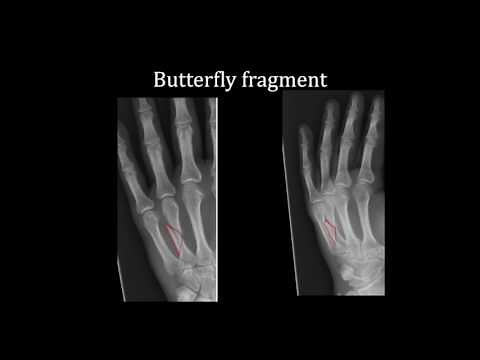 Interpreting Hand X-rays