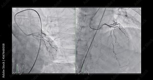 Cardiac catheterization showing coronary arteries for diagnosis cardiac arrest .