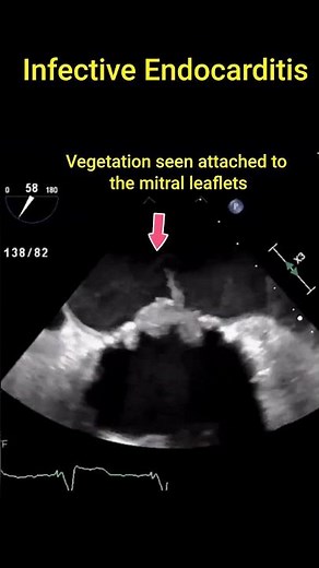 Infective Endocarditis