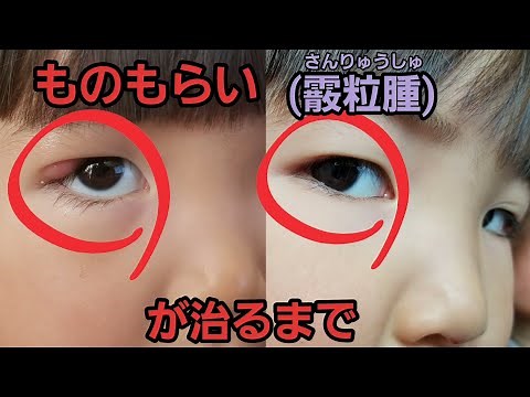 ものもらい 【霰粒腫】 めばちこが治るまでを一気にどうぞ☆