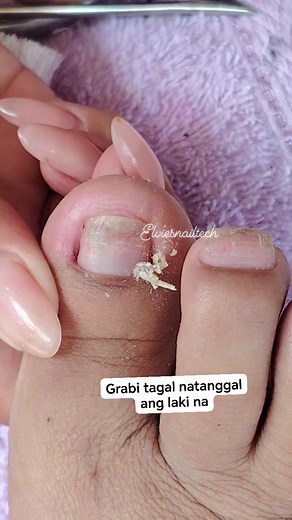 Satisfying logit😱😱 #satisfyingvideos #satisfying #satisfiedcustomer #nailcare #pediatrics #pedicure #manicurista #nailcleaning #nails #nailtech #nailtrends #nailtechlife #nailtechnician #viralnails #virals #tutorial #trending #trendingreels #followersreels #everyonefollowers #like #share #highlightseveryone #reelsvideoシ #reelsfypシ #nailsonfleek #dryskinremoval #ingrowntoenail #reelschallenge Part 3 | Elvie Gersamio