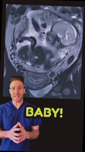 Abdominal ectopic pregnancy is a rare form of ectopic pregnancy where the embryo implants outside the uterus, specifically within the abdominal cavity. This condition poses significant risks due to the potential for internal bleeding, as the abdominal organs and vessels can be involved. Diagnosis often involves imaging techniques such as ultrasound or MRI to locate the embryo, and treatment typically requires surgical intervention to remove the embryo and repair any affected tissues. #ectopicpre