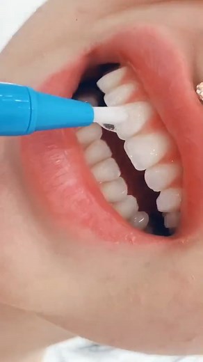 6.3K views · 50 reactions | #teethwhitening #teeth #whiteteeth #dientes #dentist #dentista #beauty #teethchallenge #wisdomteeth #yel | Edith Galvez | Facebook