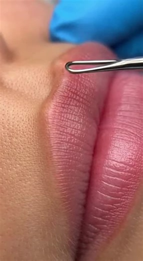 Remove Blackheads from Lips Safely