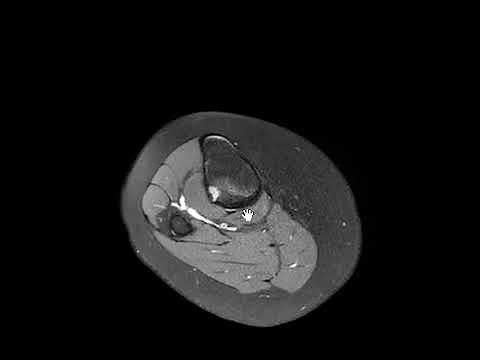 Non ossifying fibroma tibia (fibrous cortical defect)