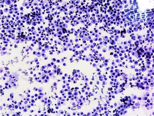 @pathologyinsight | Image-1: FNAC smear from the parotid swelling showing atypical large plasmacytoid cells. Image-2: Lymph node biopsy (H&E) showing large... | Instagram