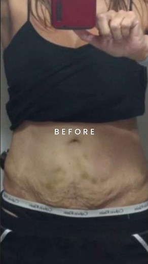 FasciaBlasting STOMACH Before and After